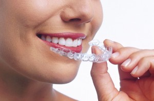 Invisalign aligner