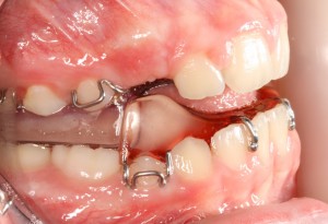 buccal view with twin blocks cropped