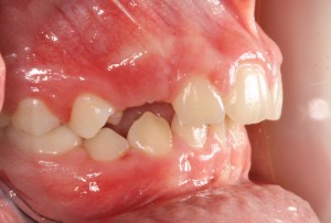 buccal view without twin blocks cropped